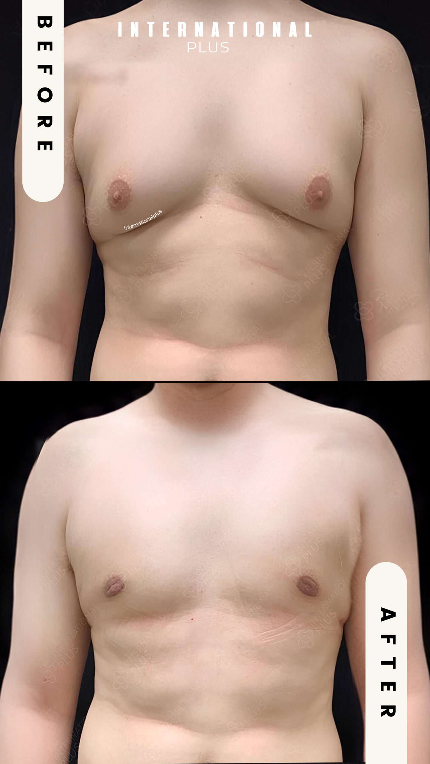 Body Procedures