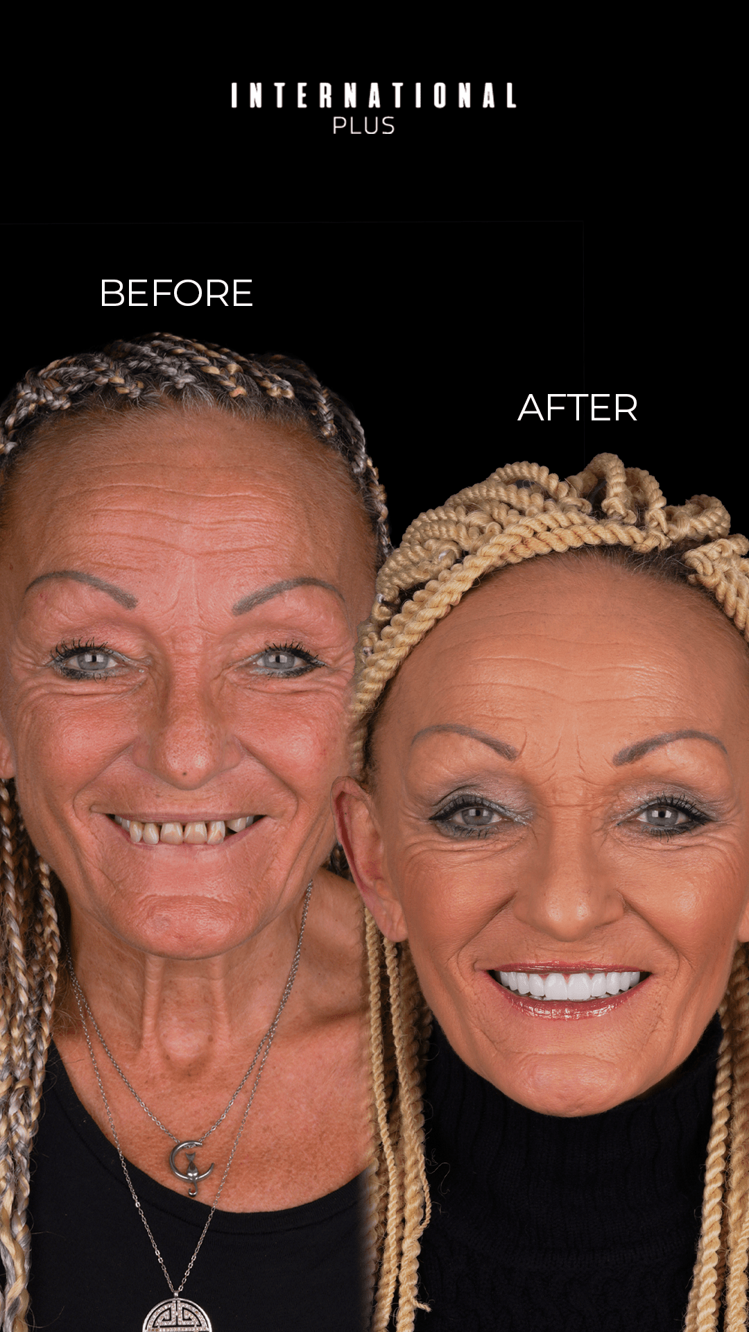 Dental Implants