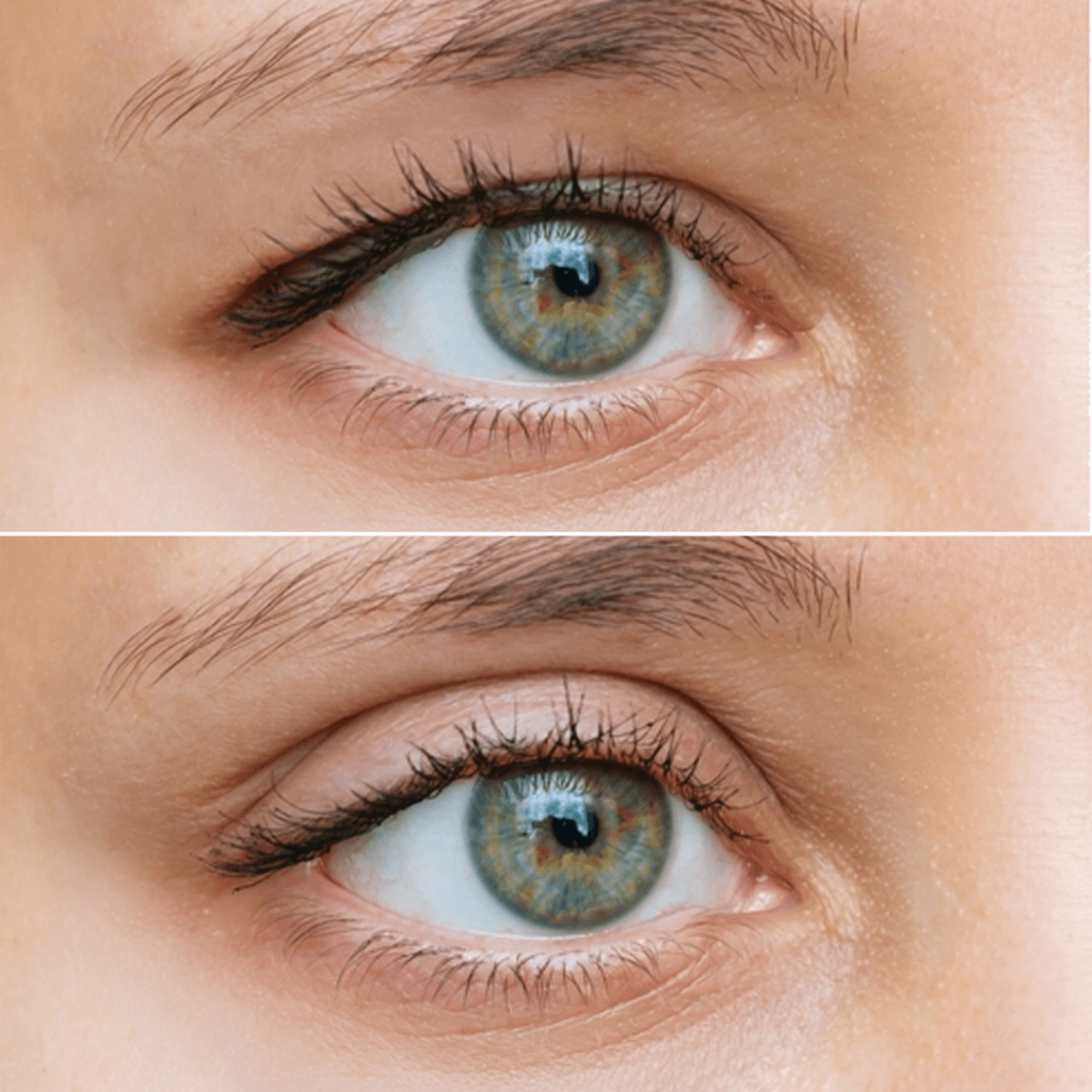 Advantages of Eyelid Surgery Dimond Clinic Poole, Sandbanks